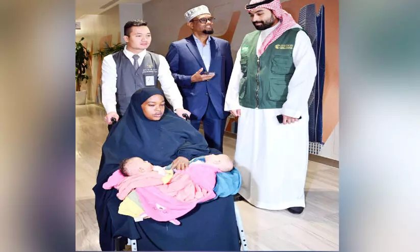 somaliyan sayameese twins in riyad somaliyan sayameese twins in riyad