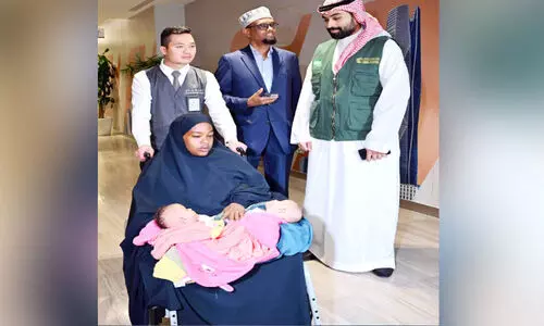 somaliyan sayameese twins in riyad