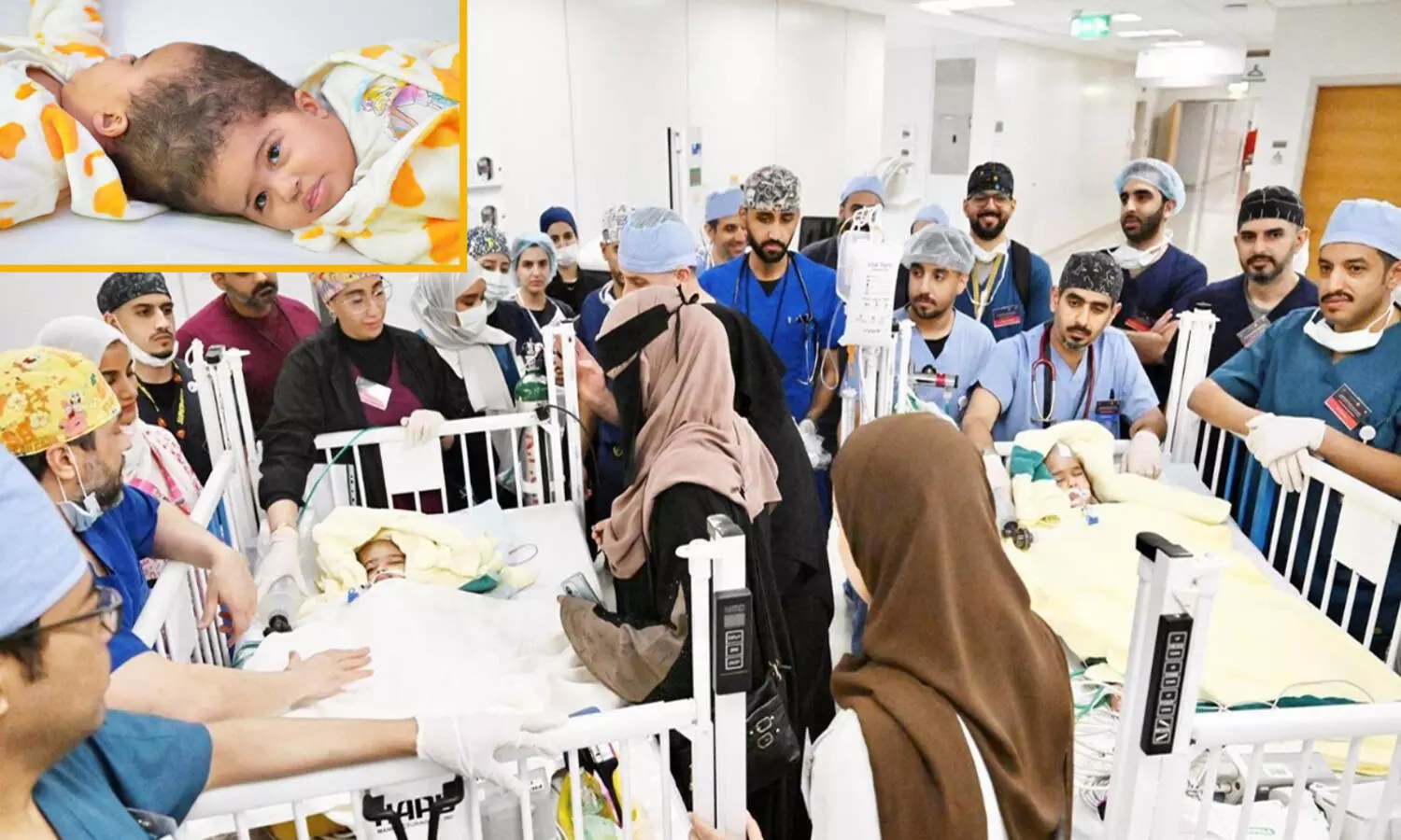 പതിനഞ്ചര മണിക്കൂർ നീണ്ട ശസ്​ത്രക്രിയ; എരിത്രിയൻ സയാമീസ്​ ഇരട്ടകൾ​ക്ക് ഇനി രണ്ടു ജീവിതം