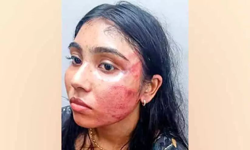 തെളിവ്​ എന്‍റെ മുഖത്തുണ്ട്; അധിക്ഷേപിക്കുന്ന   സഹപ്രവർത്തകരോട്​ ശ്യമിലി