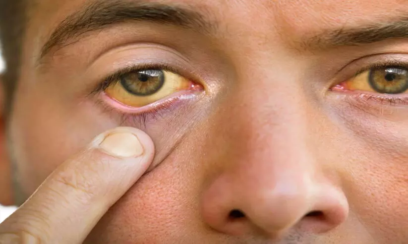 മ​ഞ്ഞ​പ്പി​ത്തം ബാ​ധി​ച്ചയാൾക്ക് തു​ണ​യാ​യി എ​റ​ണാ​കു​ളം അ​സോ​സി​യേ​ഷ​ൻ