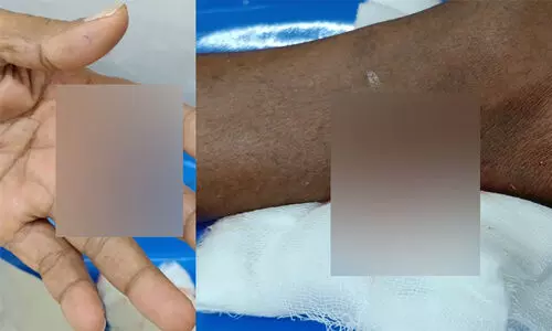 രണ്ടു​പേരെ തെരുവുനായ് കടിച്ചു; കുട ഉപയോഗിച്ച് നായെ അടിച്ചോടിച്ചു