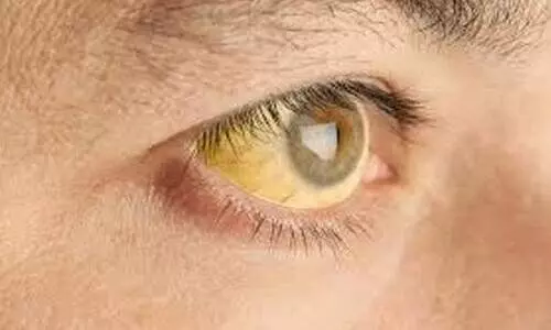 കിഴക്കോത്ത് പന്നൂരിൽ മഞ്ഞപ്പിത്തം പടരുന്നു കിഴക്കോത്ത് പന്നൂരിൽ മഞ്ഞപ്പിത്തം പടരുന്നു