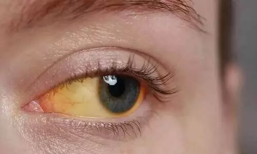 വി​വാ​ഹ സ​ൽ​ക്കാ​ര​ത്തി​ൽ പ​ങ്കെ​ടു​ത്ത 50ഓ​ളം പേ​ര്‍ക്ക് മ​ഞ്ഞ​പ്പി​ത്തം