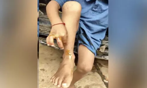 മ​ക​നെ ഇ​രു​മ്പു​ക​മ്പി ചൂ​ടാ​ക്കി പൊ​ള്ള​ലേ​ൽ​പി​ച്ച യു​വ​തി അ​റ​സ്റ്റി​ൽ