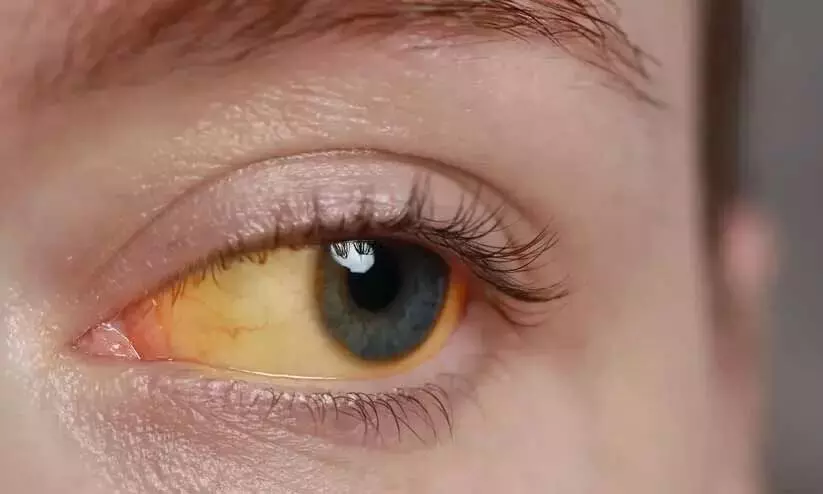 ജി​ല്ല​യി​ൽ മ​ഞ്ഞ​പ്പി​ത്തം പ​ട​ർ​ന്നു​പി​ടി​ക്കു​ന്നു