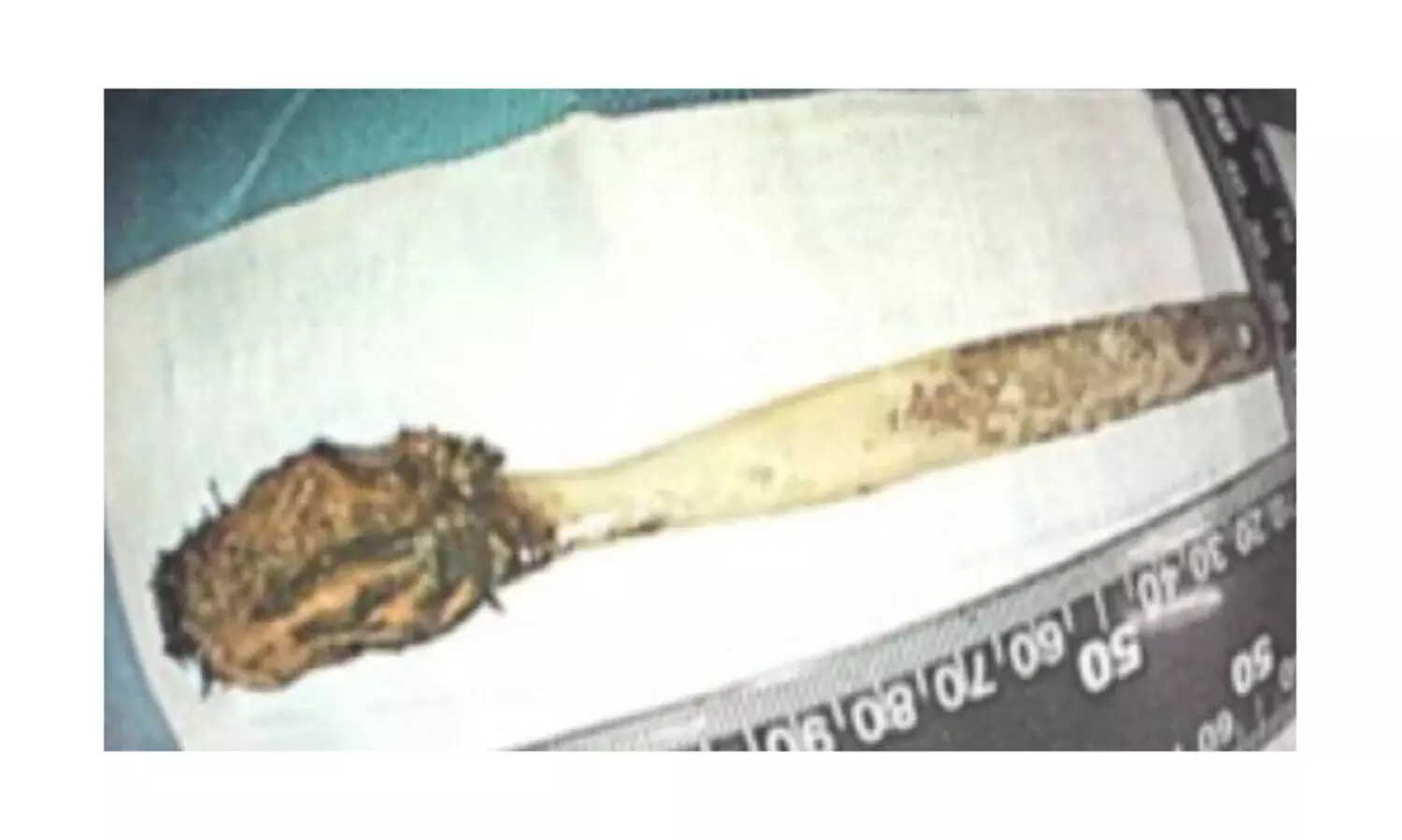 52 വർഷം നീണ്ട വയറുവേദന; ഒടുവിൽ ശസ്ത്രക്രിയയിലൂടെ പുറത്തെടുത്തത് 12ാം വയസിൽ വിഴുങ്ങിയ ടൂത്ത്ബ്രഷ്