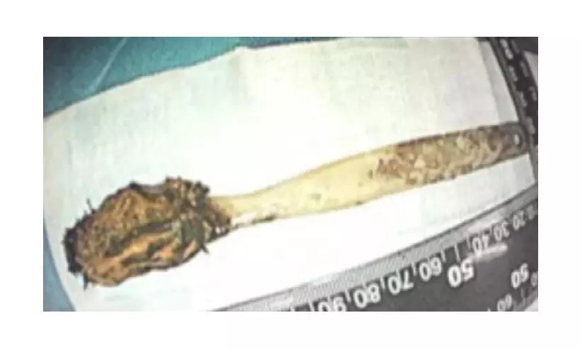 52 വർഷം നീണ്ട വയറുവേദന; ഒടുവിൽ ശസ്ത്രക്രിയയിലൂടെ പുറത്തെടുത്തത് 12ാം വയസിൽ വിഴുങ്ങിയ ടൂത്ത്ബ്രഷ് 52 വർഷം നീണ്ട വയറുവേദന; ഒടുവിൽ ശസ്ത്രക്രിയയിലൂടെ പുറത്തെടുത്തത് 12ാം വയസിൽ വിഴുങ്ങിയ ടൂത്ത്ബ്രഷ്