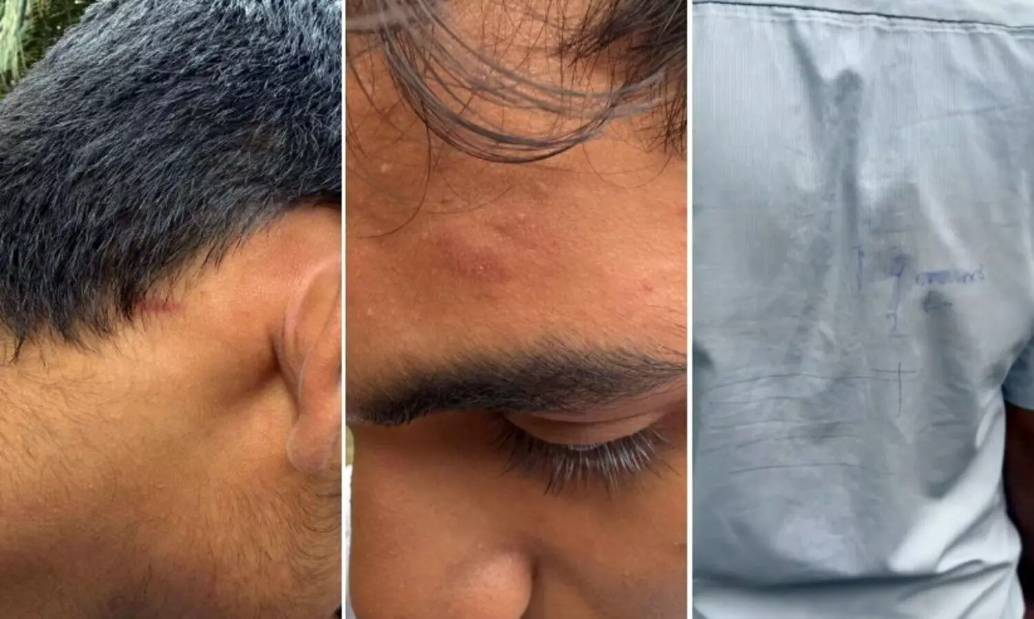 യൂനിഫോമിൽ കുത്തിവരച്ചത് ചോദ്യംചെയ്തു; പ്ലസ്ടു വിദ്യാർഥിക്ക് ക്രൂരമർദനം, കേസെടുത്ത് പൊലീസ്