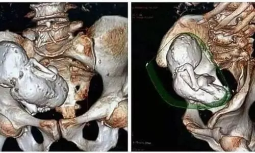 73കാരിയുടെ വയറ്റിൽ 30 വർഷം പഴക്കമുള്ള ​കല്ലുബേബി; ഞെട്ടിത്തരിച്ച് നെറ്റിസൺസ്