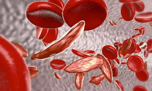 ആദിവാസി മേഖലകളിൽ 20 ലക്ഷം പേരെ അരിവാൾ രോഗ പരിശോധനക്ക് വിധേയമാക്കിയെന്ന് സി.എസ്.ഐ.ആർ ഡയറക്ടർ ജനറൽ; രോഗ നിർണയക്കിറ്റിൽ വലിയ പ്രതീക്ഷ