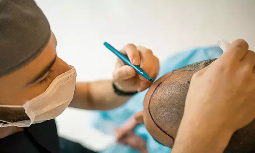 ഹെയർ ട്രാൻസ്​പ്ലാന്‍റ്​ ചെയ്യാൻ അവകാശമുണ്ടെന്ന്​ എ.ഒ.എം.എസ്.ഐ