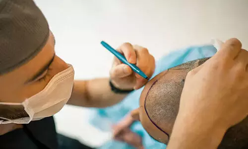 ഹെയർ ട്രാൻസ്​പ്ലാന്‍റ്​ ചെയ്യാൻ അവകാശമുണ്ടെന്ന്​ എ.ഒ.എം.എസ്.ഐ