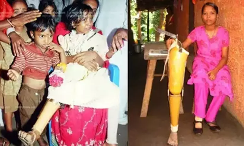 ബോംബ് ആക്രമണത്തെ തുടർന്ന് കൃത്രിമ കാൽ വച്ച അസ്ന