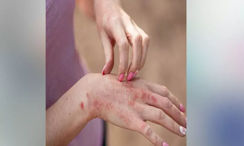 ചൂ​ട് ഉ​യ​രു​ന്നു; വേ​ണം ച​ർ​മ സം​ര​ക്ഷ​ണം