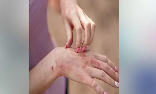 ചൂ​ട് ഉ​യ​രു​ന്നു; വേ​ണം ച​ർ​മ സം​ര​ക്ഷ​ണം