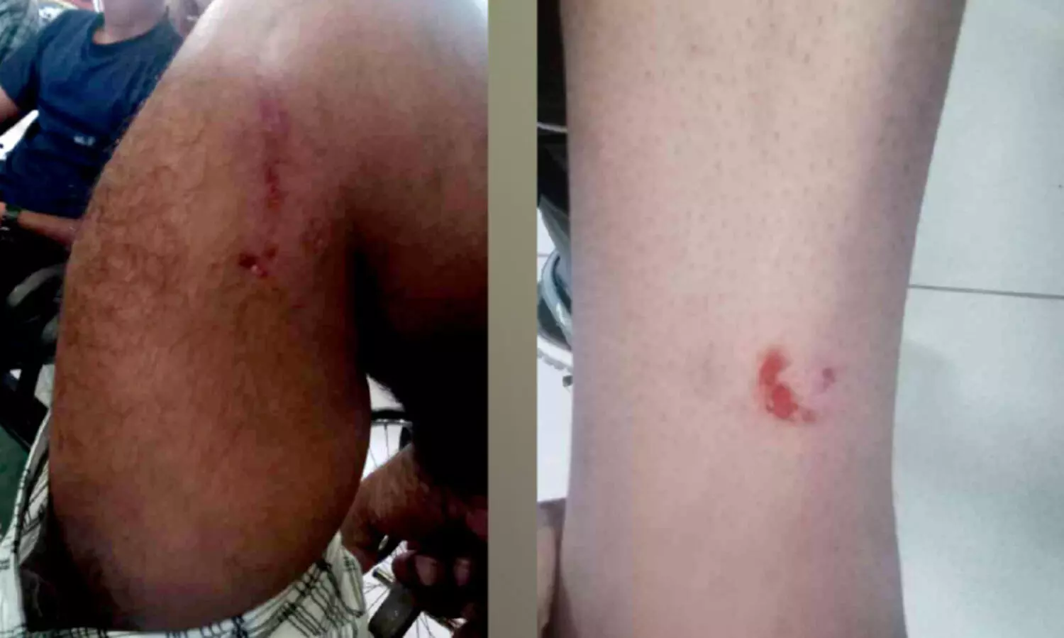 നായയുടെ കടിയേറ്റ്​ കുട്ടികളടക്കം ഏഴുപേർക്ക് പരിക്ക്