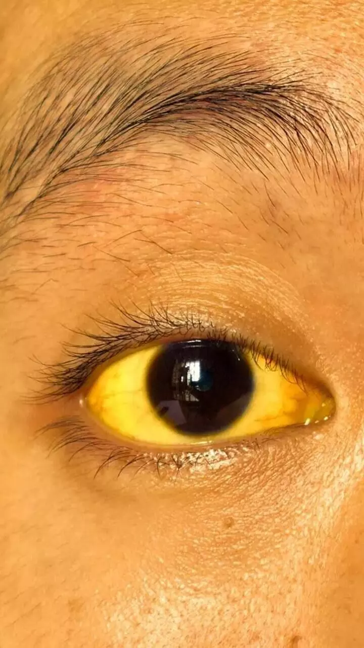 കരൾ അപകടാവസ്ഥയിലാണെന്നതിന്‍റെ 10 ലക്ഷണങ്ങൾ