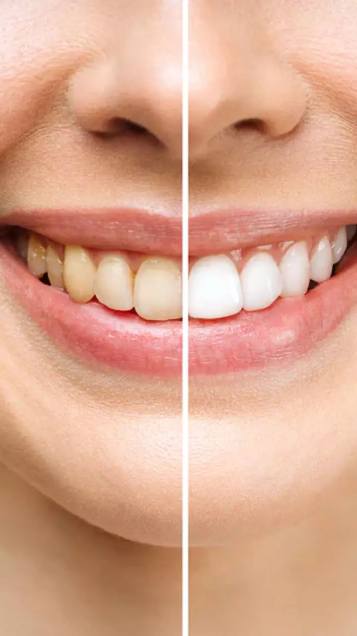 പല്ലിലെ മഞ്ഞക്കറ കളഞ്ഞ് വെളുപ്പിക്കാനുള്ള എളുപ്പ വഴികൾ