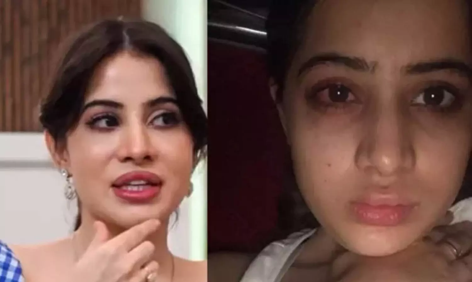 ചുണ്ടിന് സൗന്ദര്യം കൂട്ടാൻ ചികിത്സ, തടിച്ചുവീർത്തു, ലിപ് ഫില്ലർ പണി തന്നുവെന്ന് ഉർഫി ജാവേദ്