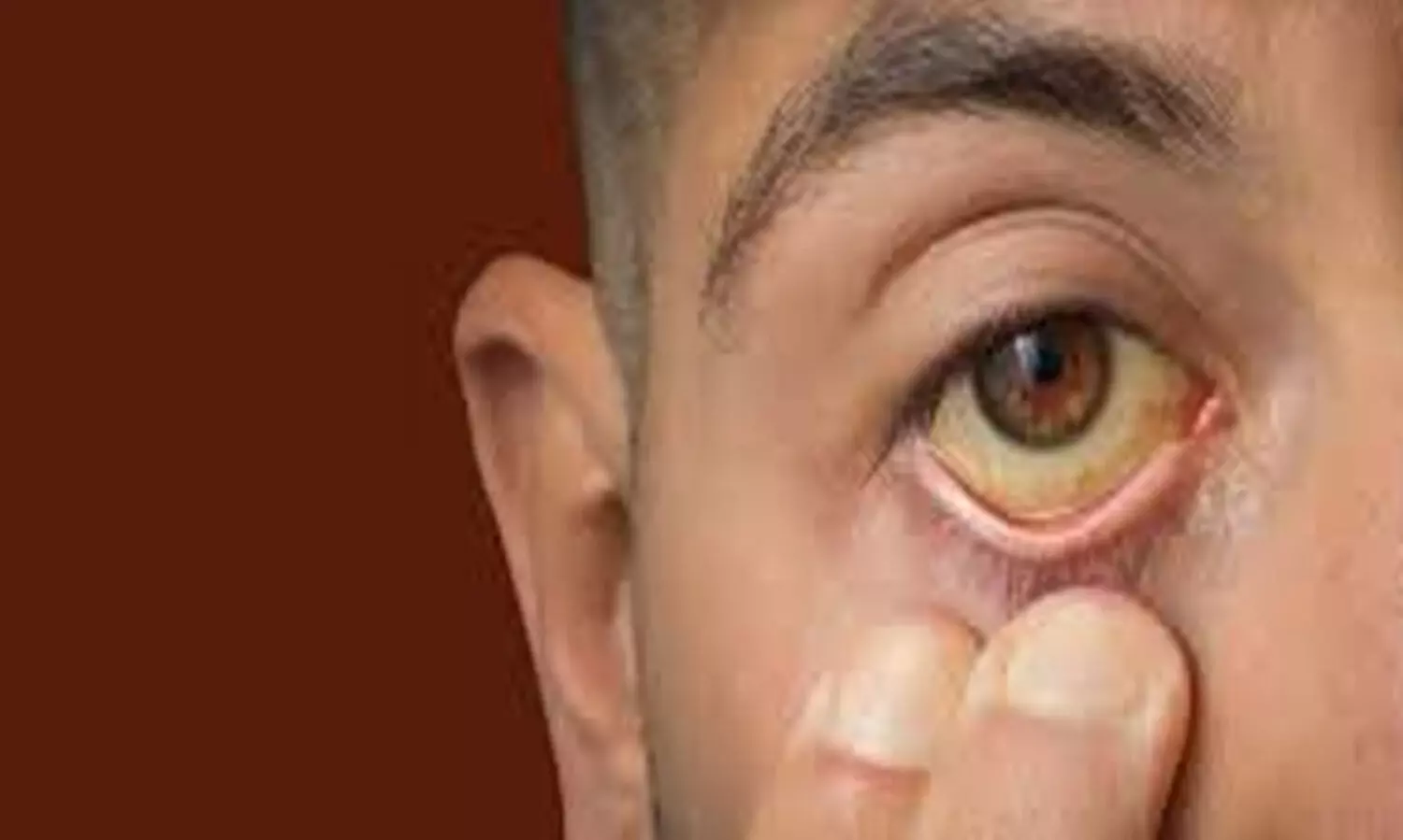 ആലങ്ങാട് മഞ്ഞപ്പിത്തവും  ഡെങ്കിപ്പനിയും വ്യാപിക്കുന്നു