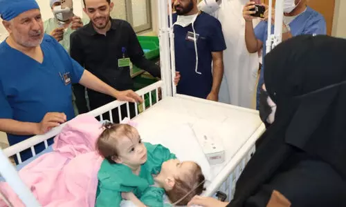 Syrian conjoined twins separated
