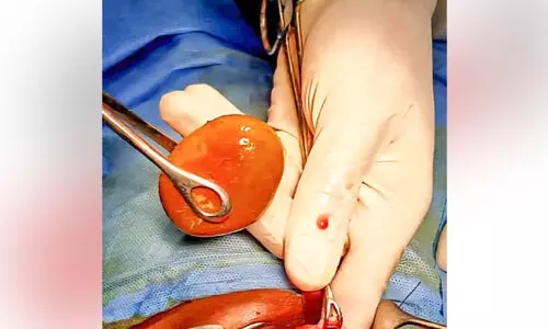 പരിമിത സാഹചര്യങ്ങളിൽ ശസ്ത്രക്രിയ; വയോധികന്റെ മൂത്രസഞ്ചിയിൽ നിന്ന് ആറ് സെന്റിമീറ്റർ വലിപ്പമുള്ള കല്ല് നീക്കം ചെയ്തു പരിമിത സാഹചര്യങ്ങളിൽ ശസ്ത്രക്രിയ; വയോധികന്റെ മൂത്രസഞ്ചിയിൽ നിന്ന് ആറ് സെന്റിമീറ്റർ വലിപ്പമുള്ള കല്ല് നീക്കം ചെയ്തു