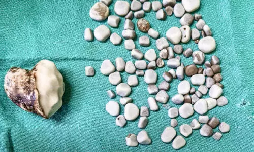 Kidney stone removed from 44 year old man