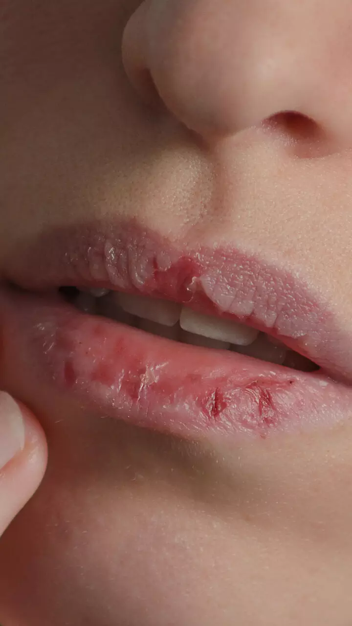 ഇവ പരീക്ഷിച്ചു നോക്കൂ, ചുണ്ടുകൾ വിണ്ടുകീറുന്നത് പൂർണമായും തടയാം