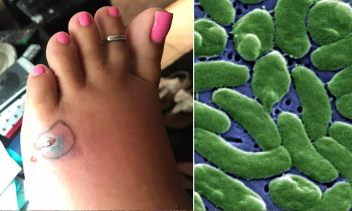 പച്ചക്ക് കഴിച്ച ഓയ്സ്റ്ററിൽ മാംസഭോജി ബാക്ടീരിയ; അണുബാധയേറ്റ് രണ്ടുമരണം