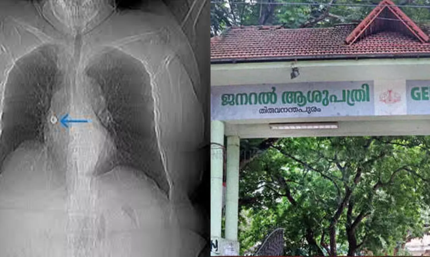 Guide wire stuck in chest incident