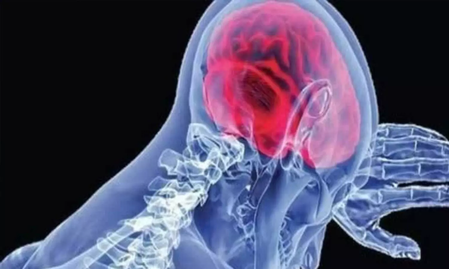 amebic meningoencephalitis