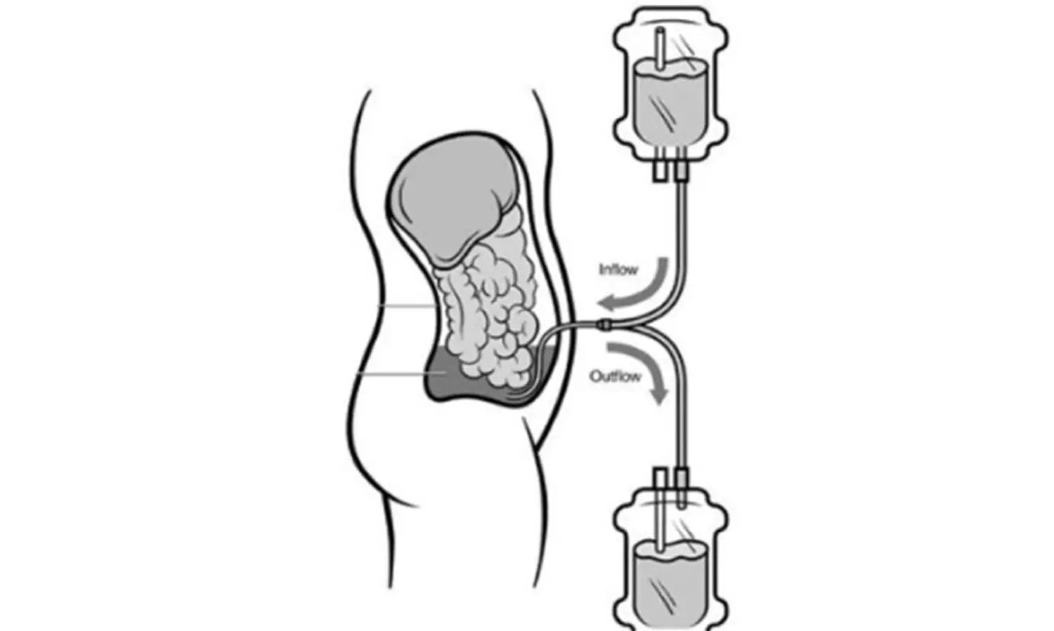 രോഗികൾ ദുരിതത്തിൽ; പെരിട്ടോണിയൽ ഡയാലിസിസ് ഫ്ലൂയിഡ് കിറ്റ് കിട്ടാനില്ല