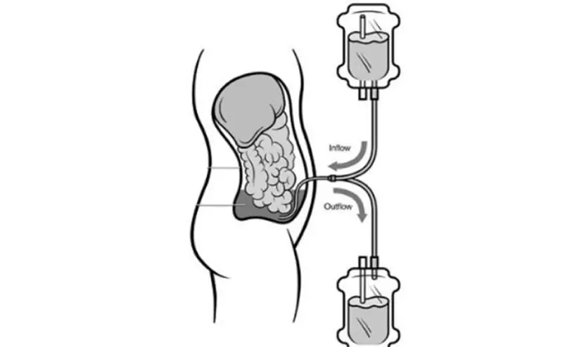 രോഗികൾ ദുരിതത്തിൽ; പെരിട്ടോണിയൽ ഡയാലിസിസ് ഫ്ലൂയിഡ് കിറ്റ് കിട്ടാനില്ല
