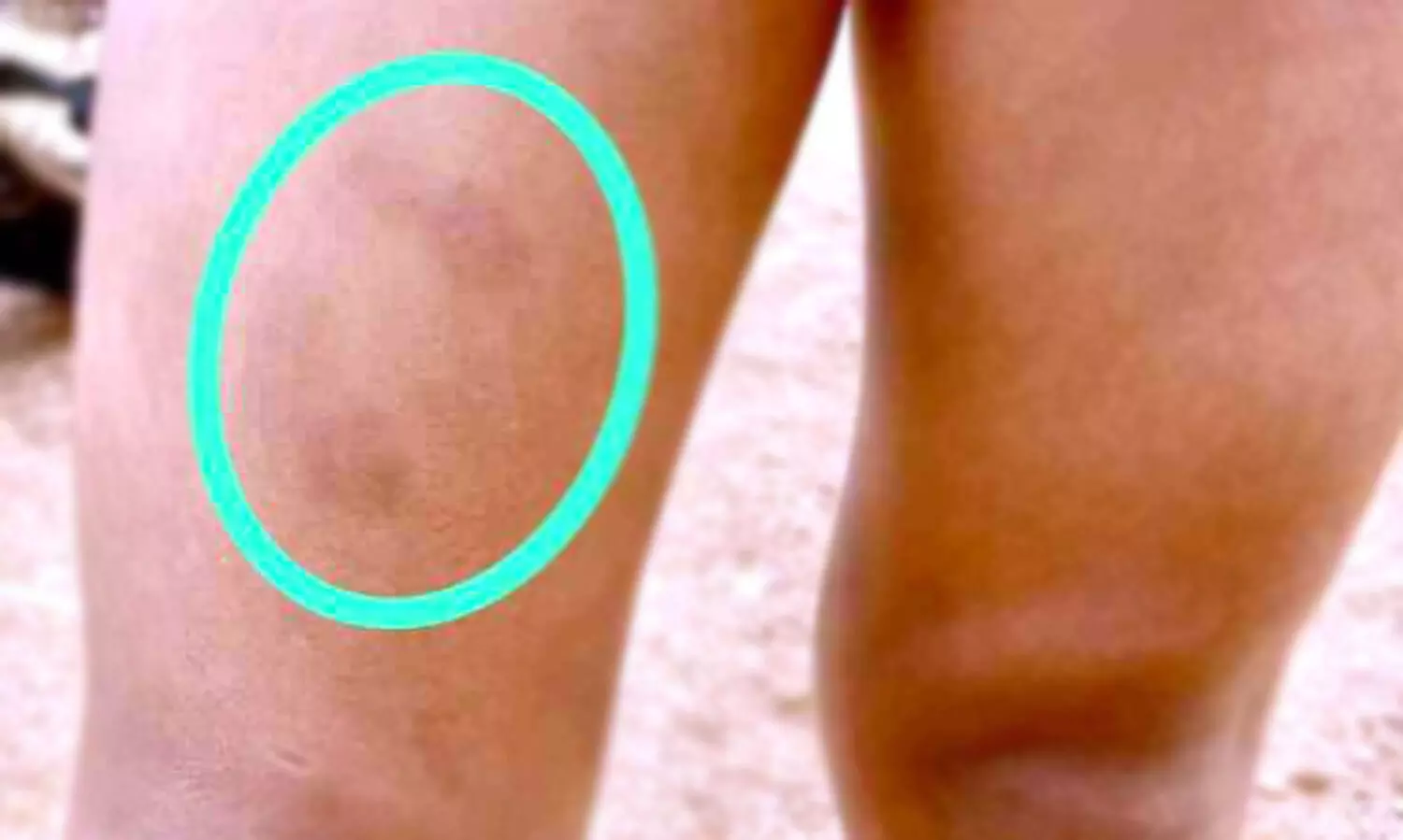 അംഗൻവാടി ടീച്ചർ കുട്ടിയെ പരിക്കേൽപിച്ചതായി പരാതി