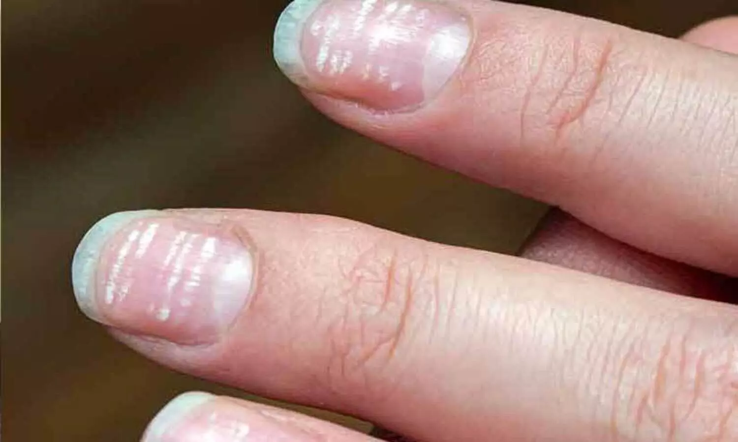 നഖങ്ങളിൽ വെളുത്ത വരകളോ​? പല ഗുരുതര രോഗങ്ങളുടെയും ലക്ഷണമാകാം