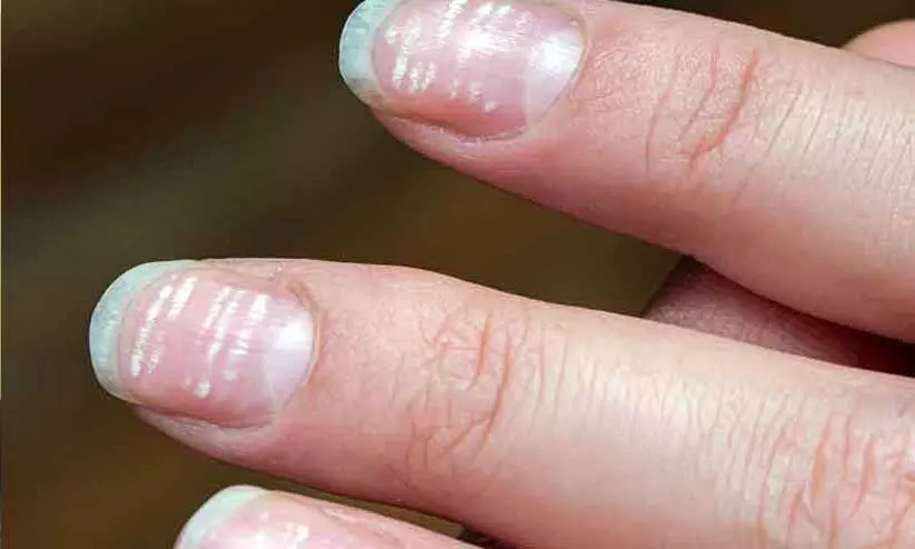 നഖങ്ങളിൽ വെളുത്ത വരകളോ? പല ഗുരുതര രോഗങ്ങളുടെയും ലക്ഷണമാകാം നഖങ്ങളിൽ വെളുത്ത വരകളോ? പല ഗുരുതര രോഗങ്ങളുടെയും ലക്ഷണമാകാം