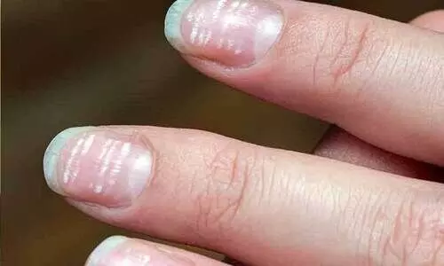 നഖങ്ങളിൽ വെളുത്ത വരകളോ​? പല ഗുരുതര രോഗങ്ങളുടെയും ലക്ഷണമാകാം