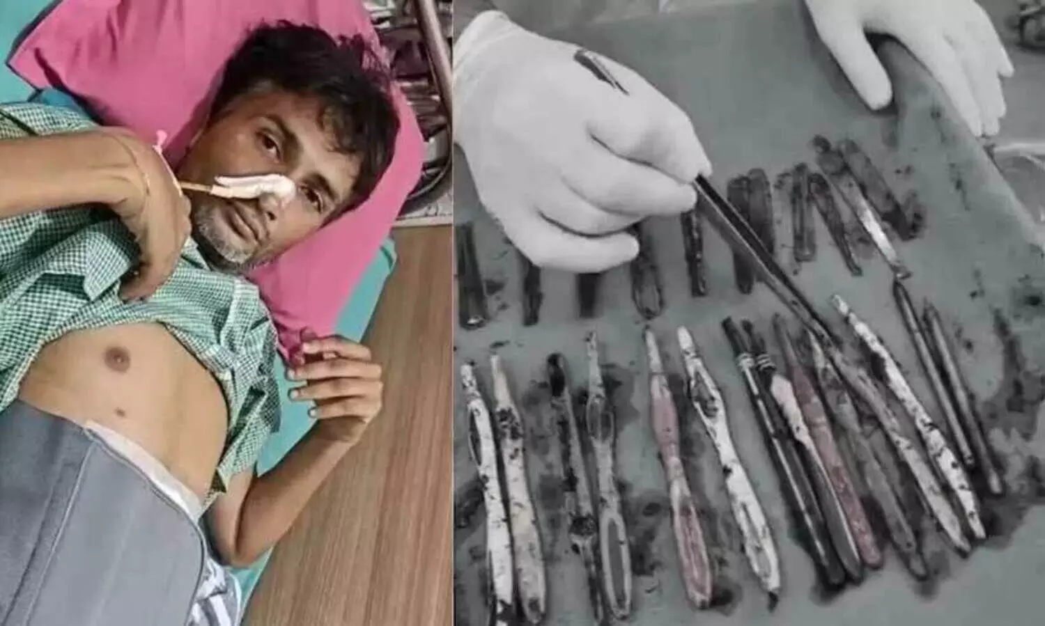 urgical removal,ingested items,rare case,hospital procedure,abdominal surgery,ഉത്തർപ്രദേശ്, ശസ്ത്രക്രിയ