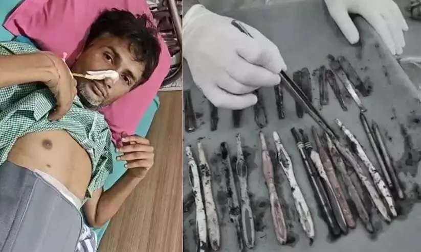 urgical removal,ingested items,rare case,hospital procedure,abdominal surgery,ഉത്തർപ്രദേശ്, ശസ്ത്രക്രിയ urgical removal,ingested items,rare case,hospital procedure,abdominal surgery,ഉത്തർപ്രദേശ്, ശസ്ത്രക്രിയ