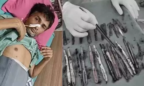 urgical removal,ingested items,rare case,hospital procedure,abdominal surgery,ഉത്തർപ്രദേശ്, ശസ്ത്രക്രിയ