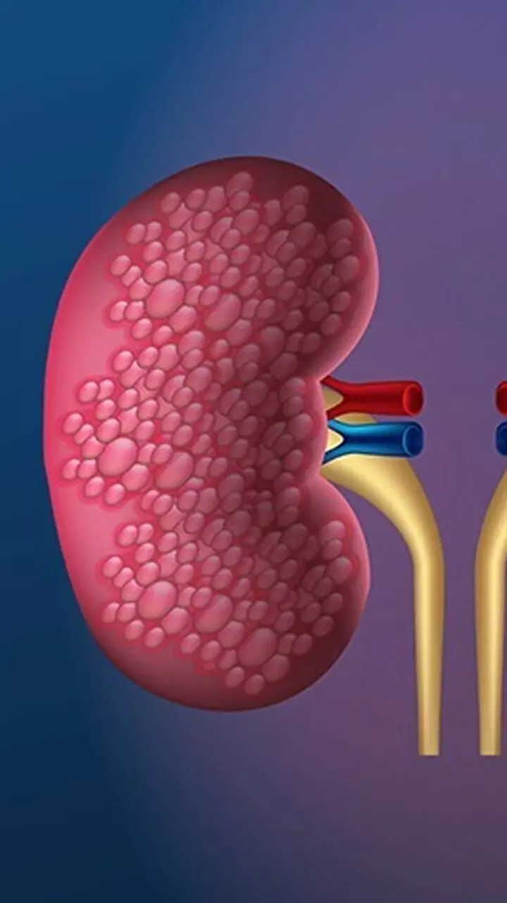 വൃക്കരോഗം ആരംഭത്തിൽ തന്നെ തിരിച്ച  റിയാം, ഈ 7 ലക്ഷണങ്ങളിലൂടെ