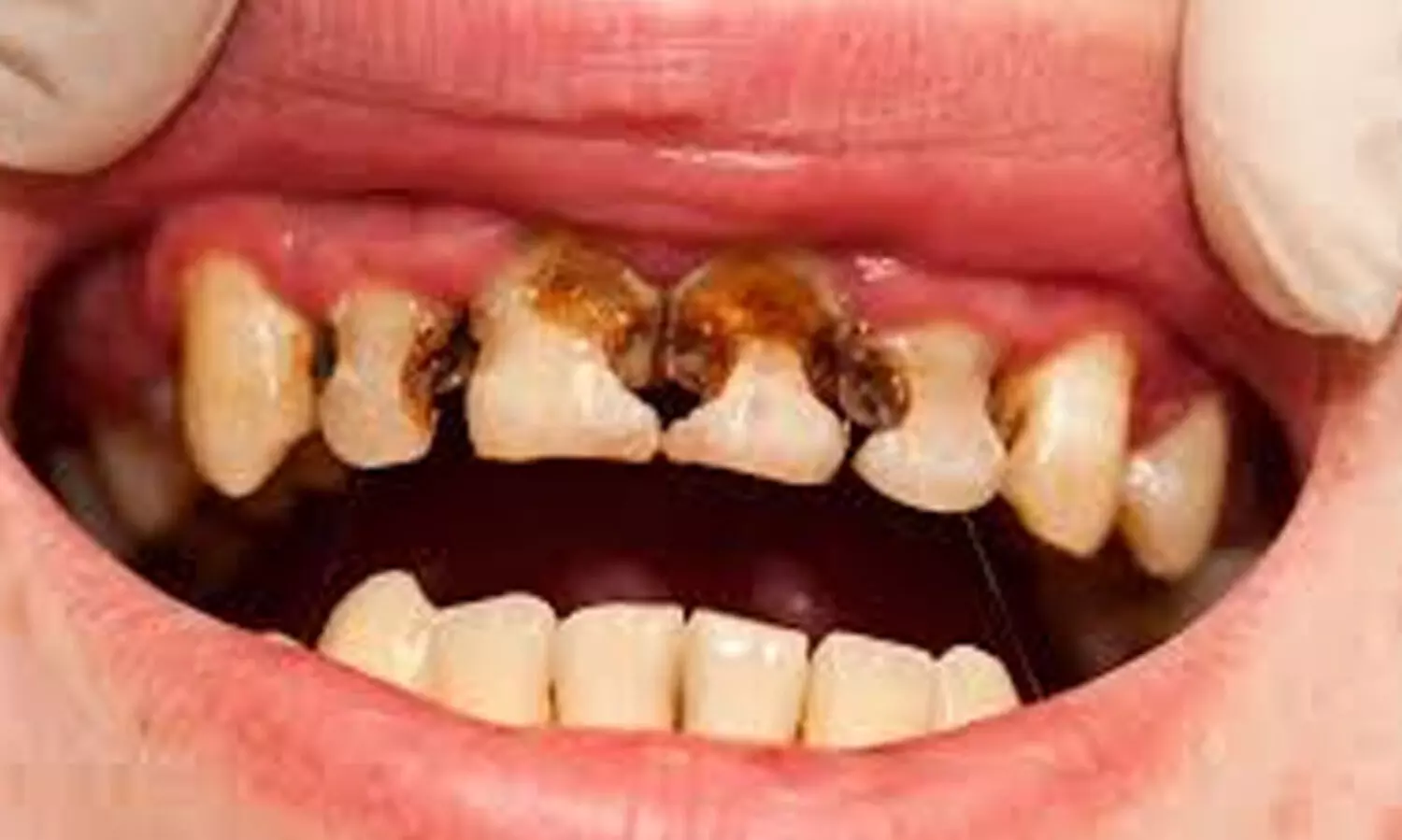 പുഴുപ്പല്ല് വരാതിരിക്കാൻ ഡോക്ടർമാർ ഒഴിവാക്കണമെന്ന് നിർദേശിക്കുന്ന ഭക്ഷണങ്ങൾ