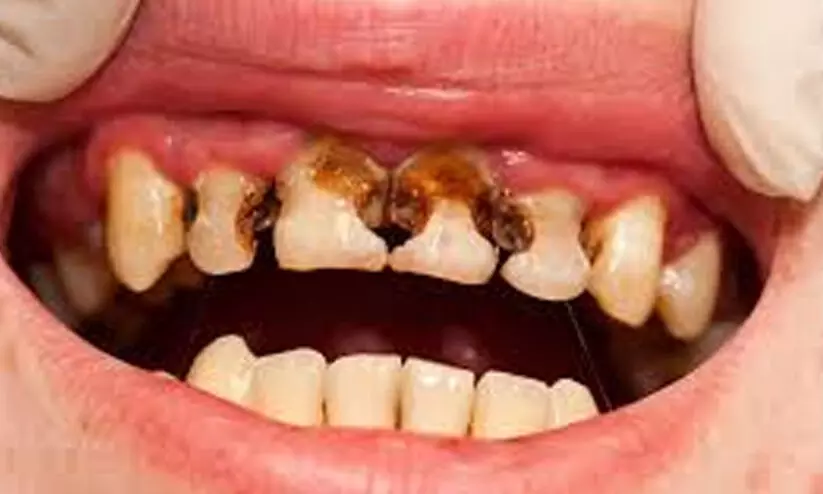 പുഴുപ്പല്ല് വരാതിരിക്കാൻ ഡോക്ടർമാർ ഒഴിവാക്കണമെന്ന് നിർദേശിക്കുന്ന ഭക്ഷണങ്ങൾ പുഴുപ്പല്ല് വരാതിരിക്കാൻ ഡോക്ടർമാർ ഒഴിവാക്കണമെന്ന് നിർദേശിക്കുന്ന ഭക്ഷണങ്ങൾ