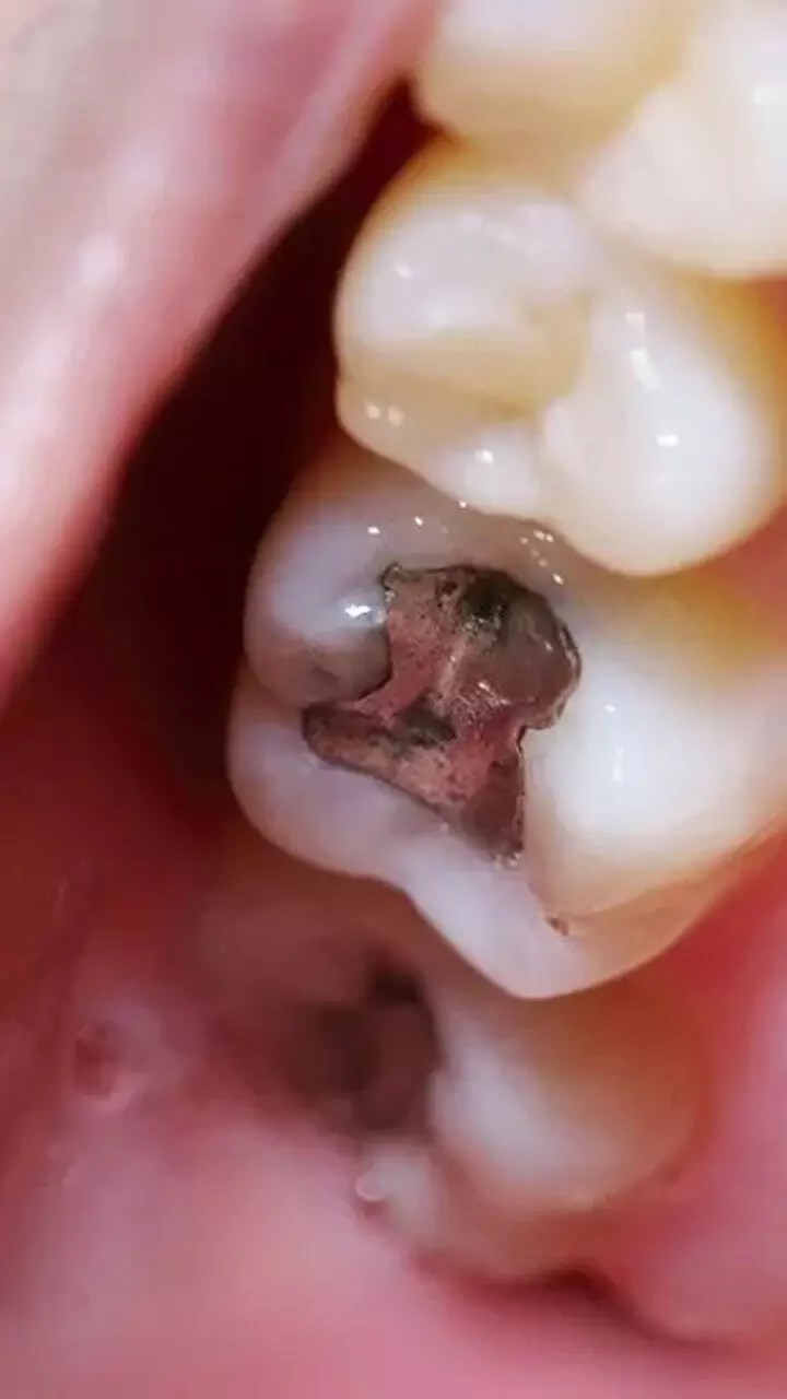 മധുരം മാത്രമല്ല, പുഴുപ്പല്ല് വരാതിരിക്കാൻ ഇവയും ഭക്ഷണത്തിൽ നിന്നൊഴിവാക്കണം