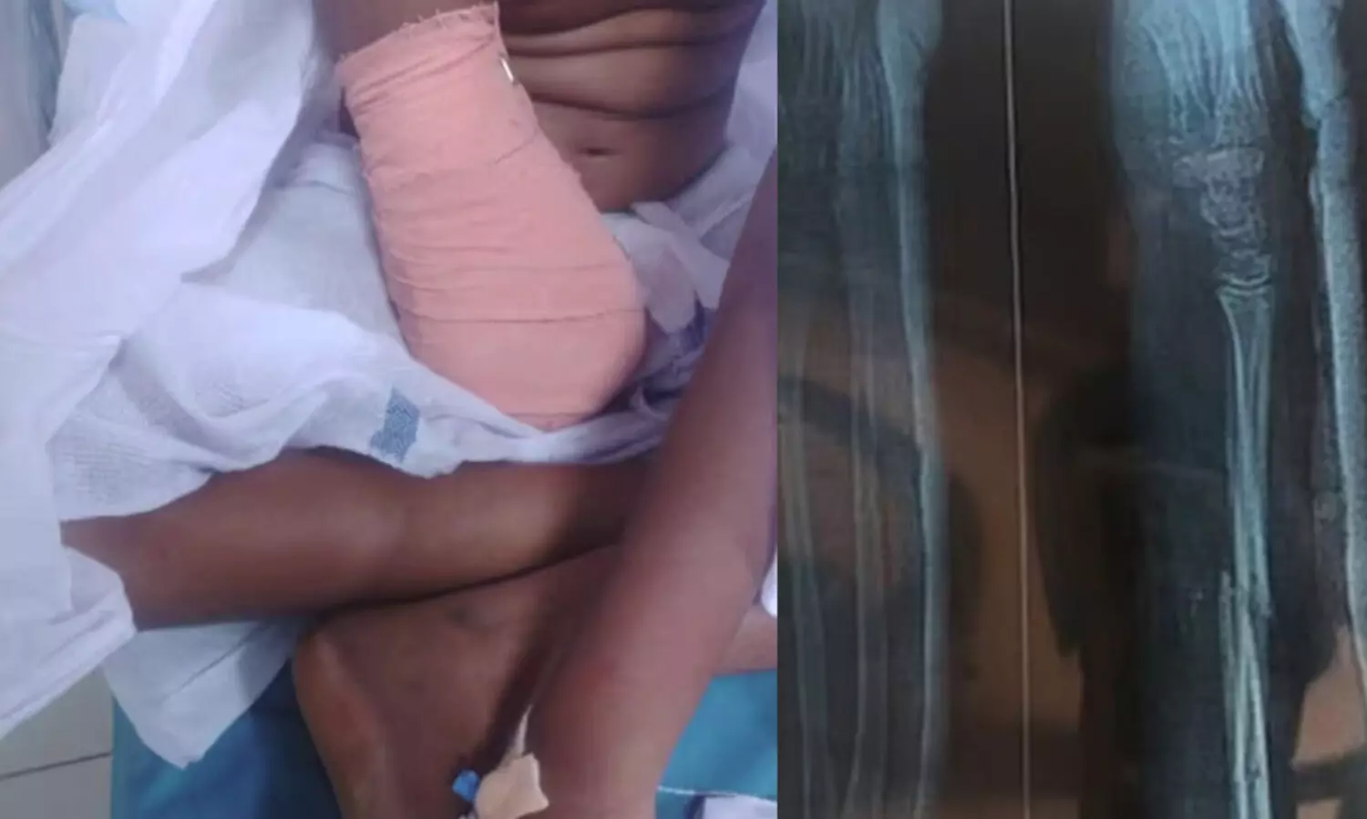 വീണ്ടും ചികിത്സാ പിഴവ്​​; വീണ് പരിക്കേറ്റ ഒമ്പതുകാരിയുടെ വലതുകൈ മുട്ടിന് മുകളിൽ മുറിച്ചു മാറ്റി