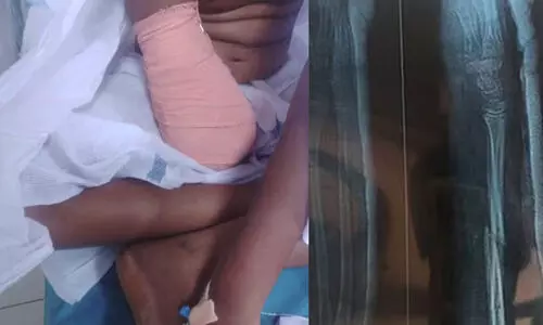 വീണ്ടും ചികിത്സാ പിഴവ്​​; വീണ് പരിക്കേറ്റ ഒമ്പതുകാരിയുടെ വലതുകൈ മുട്ടിന് മുകളിൽ മുറിച്ചു മാറ്റി