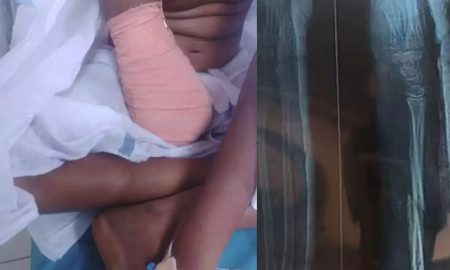 കുട്ടിയുടെ ആരോഗ്യ നിലയിൽ പുരോഗതി; ഗുരുതര വീഴ്ചയെന്ന് ഷാഫി പറമ്പില്‍ എം.പി