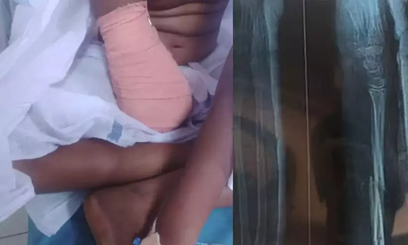 കുട്ടിയുടെ ആരോഗ്യ നിലയിൽ പുരോഗതി; ഗുരുതര വീഴ്ചയെന്ന് ഷാഫി പറമ്പില് എം.പി കുട്ടിയുടെ ആരോഗ്യ നിലയിൽ പുരോഗതി; ഗുരുതര വീഴ്ചയെന്ന് ഷാഫി പറമ്പില് എം.പി