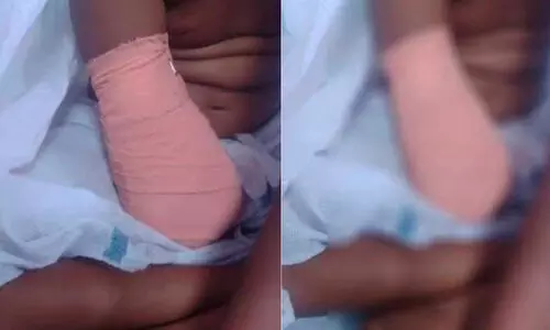 പാലക്കാട് കുട്ടിയുടെ കൈ മുറിച്ച് മാറ്റിയ സംഭവം; രണ്ട് ഡോക്ടര്‍മാര്‍ക്ക് സസ്‌പെന്‍ഷന്‍